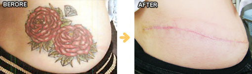形成外科的手技によるタトゥー・入れ墨除去の症例