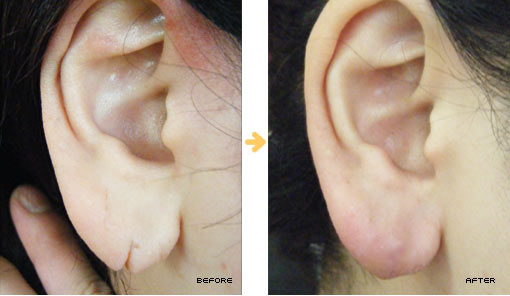 耳たぶ裂けの治療は日本形成外科学会の認定医がいる大阪のたにまちクリニックまで 医療法人秀黄会たにまちクリニック