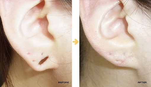 先天的、ピアスによる後天的トラブルが原因で起こる耳たぶの裂けを治療します。